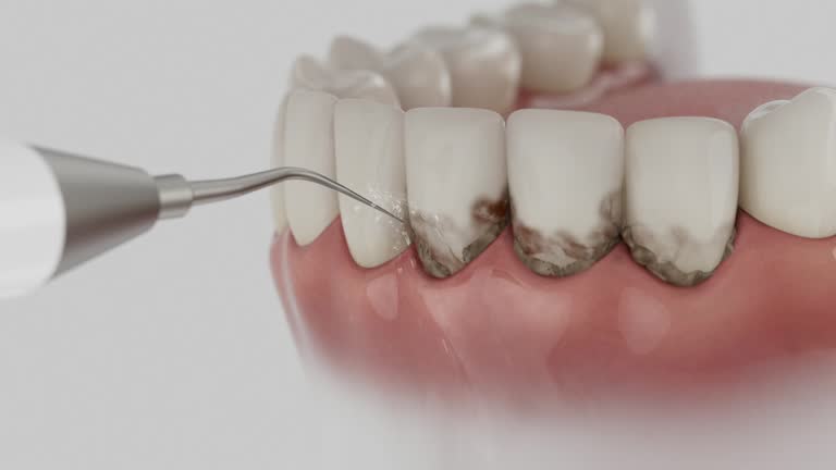Trusted Dental Crowns And Bridges service in Catonsville, MD - Dentist Open Now